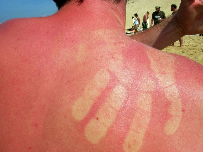 Hier schmerzt schon das Hinschauen. Gegen einen Sonnenbrand bei Kindern und Erwachsenen hilft vorbeugen: Eincremen und entsprechend anziehen. Outdoor Hersteller bieten auch UV Strahlen filternden Kinderkleidung an. Foto: William Veder / pixelio.de
